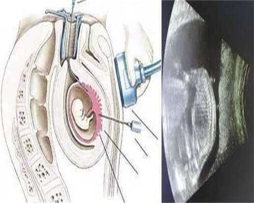 划重点！美国生命代生男孩好吗中心冻胚鲜胚移植成功率在这里
						
